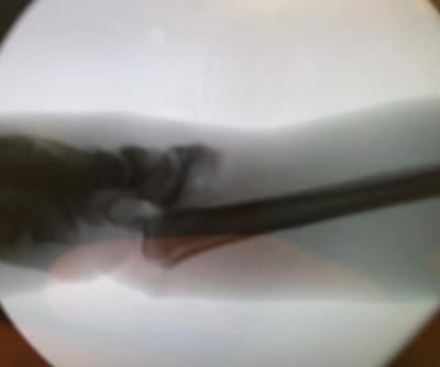 My wrist after the accident –&nbsp;it was an open fracture where the bone comes out. Everything was in bits so the surgeon had to piece it all back together.