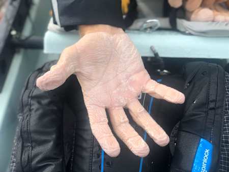 One of the MacLean brothers show the salt sores on their hands