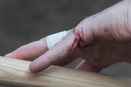 Sår hånd etter bygging av pumptrack
