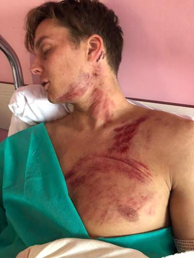 The marks all over my chest and neck are from where the bike hit me –&nbsp;we were rolling together for a bit.