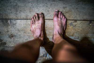 A picture of battered feet after days on the trail.