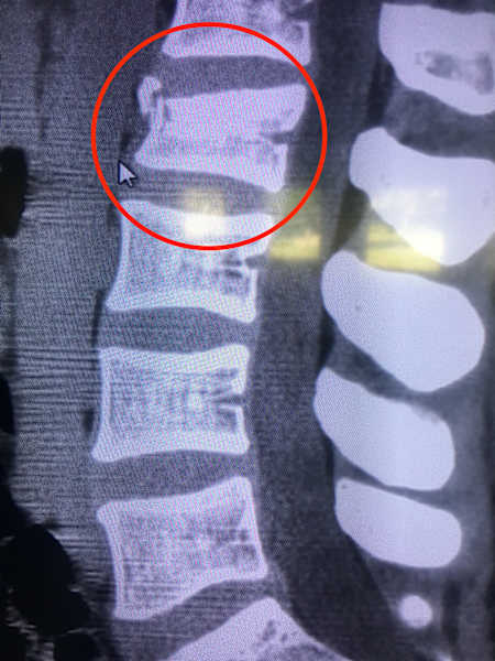 This is the x-ray of my spine –&nbsp;you can see that the vertebrae is crushed and chipped to the left hand side. It needed time to heal.