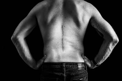 Brook MacDonald show the scars of spinal surgery at his home in Napier, New Zealand