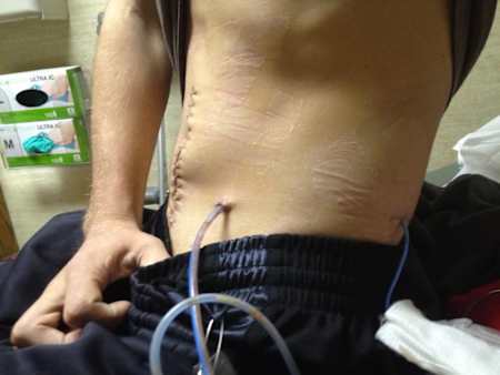 After my initial surgeries, I had a gut infection that almost killed me. Getting all of the infection out was a very long process.