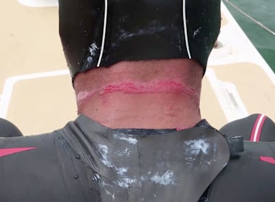 Ross's wetsuit has caused an abrasion across the back of his neck