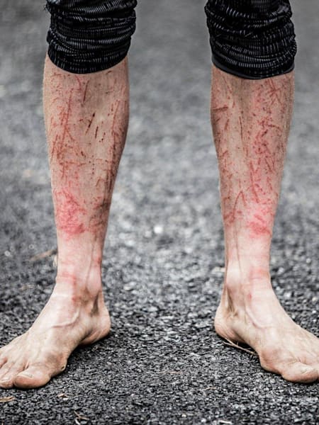 A racer shows off his battle scars in the Barkley Marathon