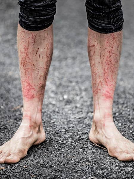 Scratched legs seen on competitor after competing in Barkley Marathon.