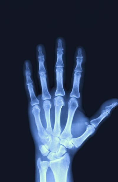 These X-Rays made bones visible and, therefore, easier to examine