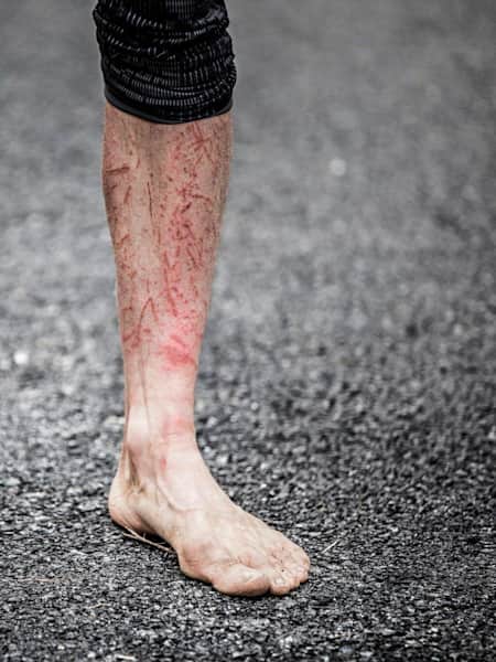 I graffi sulle gambe di un dei corridori che ha partecipato alla Barkley Marathons