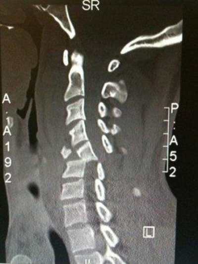 Charles had fractured his C5 and C6 vertebrae.