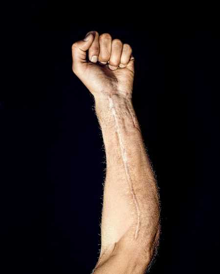 Roczen’s scarred forearm is a reminder of his 2017 crash, which snapped bones and tore ligaments.